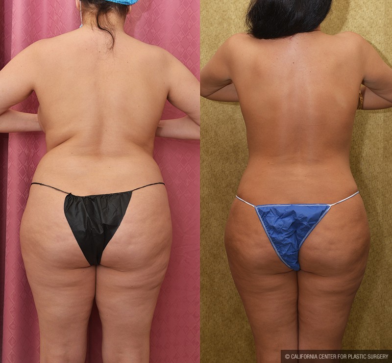 Tummy Tuck (Abdominoplasty) Medium Size Before & After Patient #14698