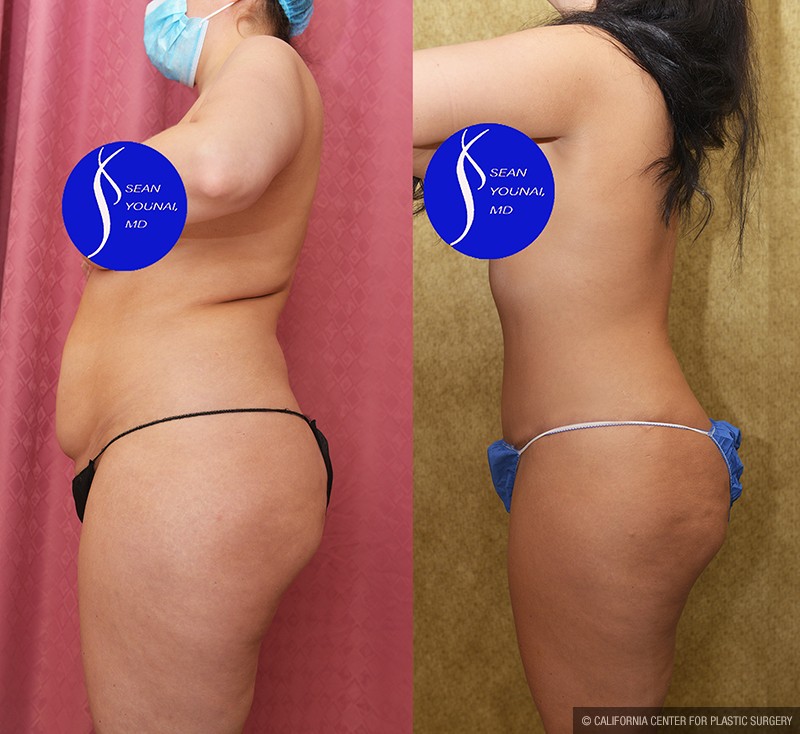 Tummy Tuck (Abdominoplasty) Medium Size Before & After Patient #14698
