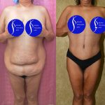 Tummy Tuck (Abdominoplasty) Plus Size Before & After Patient #14699