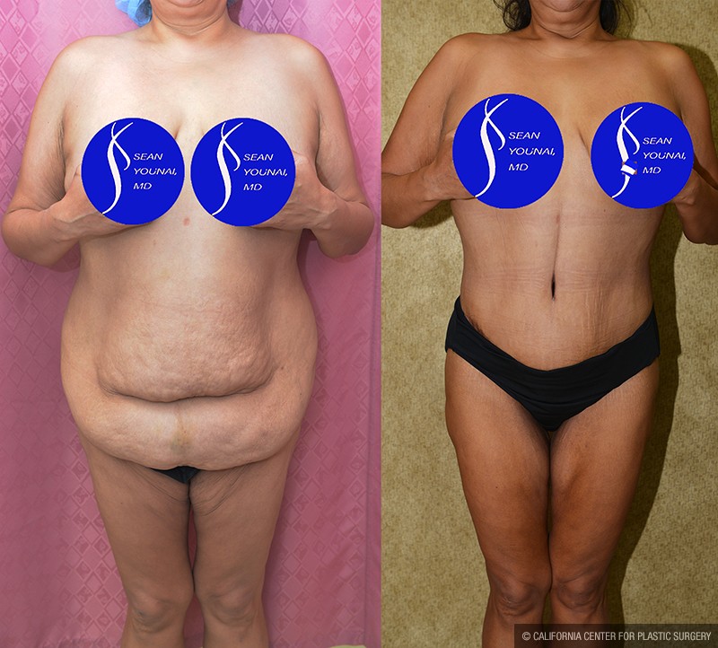 Tummy Tuck (Abdominoplasty) Plus Size Before & After Patient #14699