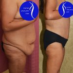 Tummy Tuck (Abdominoplasty) Plus Size Before & After Patient #14699