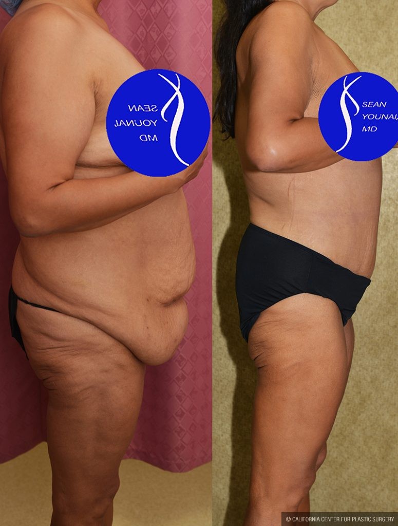 Tummy Tuck (Abdominoplasty) Plus Size Before & After Patient #14699