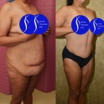 Tummy Tuck (Abdominoplasty) Plus Size Before & After Patient #14699