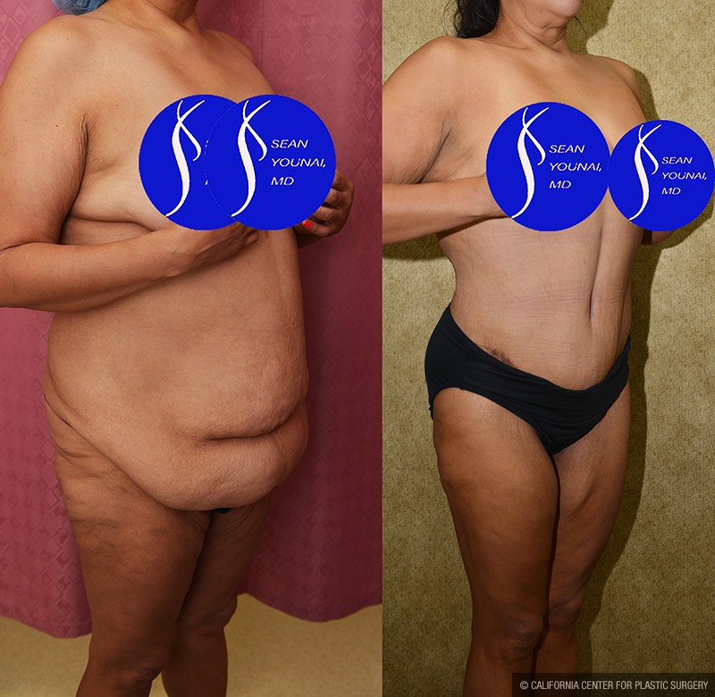 Tummy Tuck (Abdominoplasty) Plus Size Before & After Patient #14699