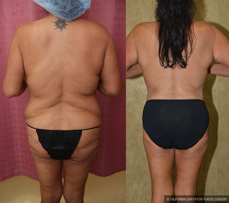 Tummy Tuck (Abdominoplasty) Plus Size Before & After Patient #14699