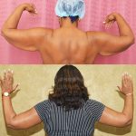 Arm Lift (Brachioplasty) Before & After Patient #14691
