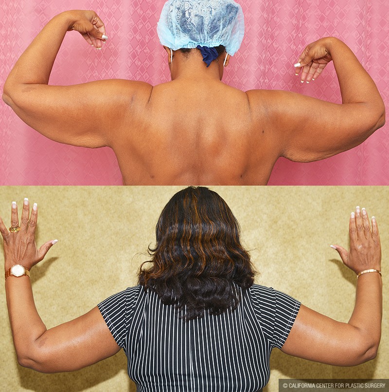 Arm Lift (Brachioplasty) Before & After Patient #14691