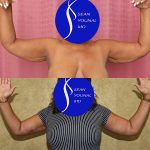 Arm Lift (Brachioplasty) Before & After Patient #14691