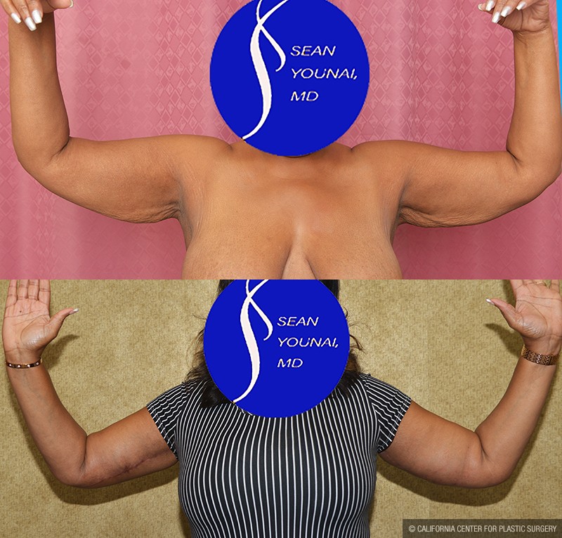 Arm Lift (Brachioplasty) Before & After Patient #14691