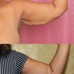 Arm Lift (Brachioplasty) Before & After Patient #14691