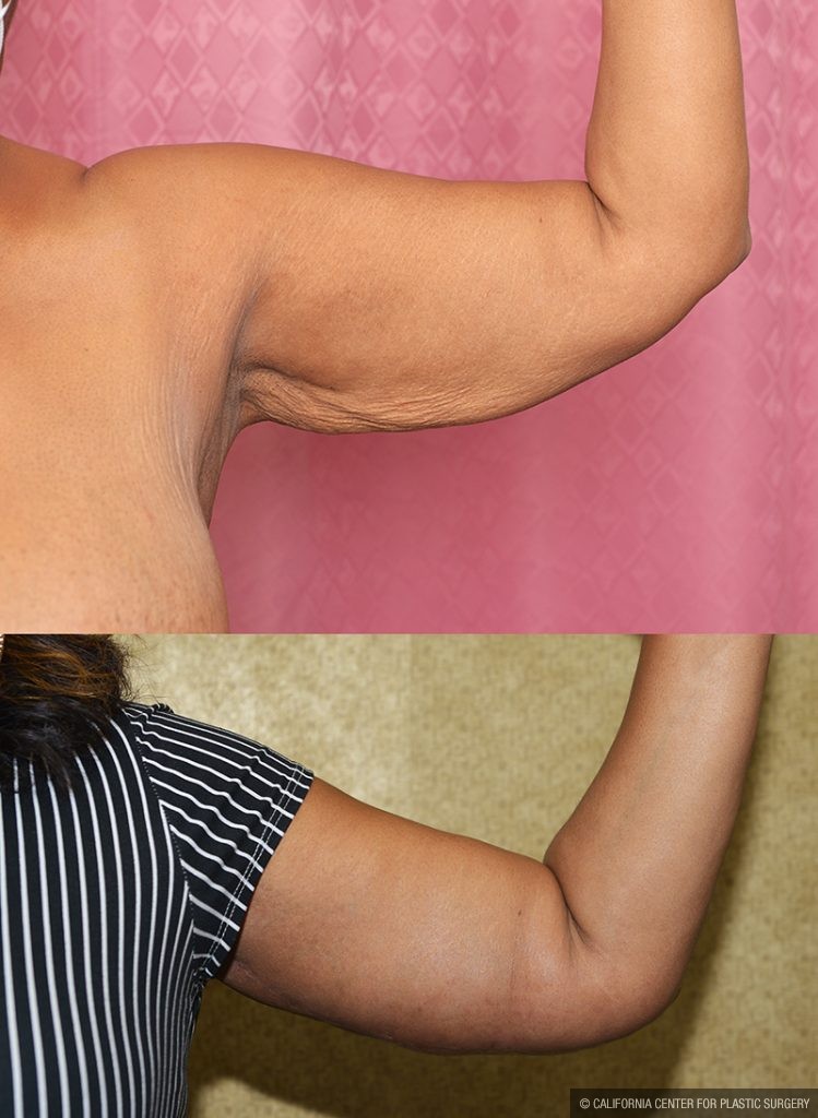 Arm Lift (Brachioplasty) Before & After Patient #14691