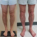 Calf Augmentation Before & After Patient #14692