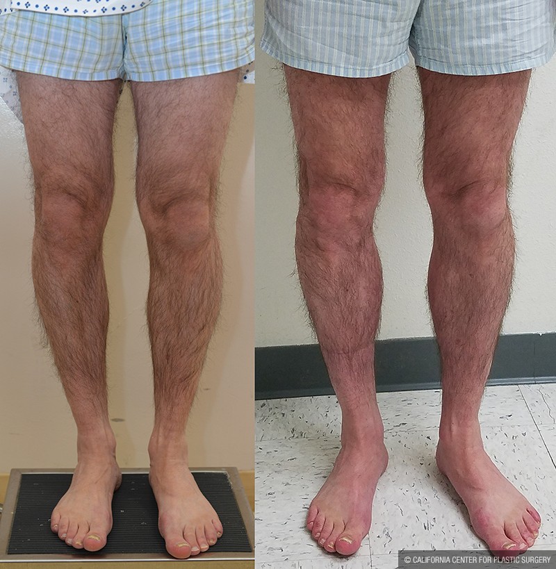 Calf Augmentation Before & After Patient #14692