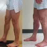 Calf Augmentation Before & After Patient #14692