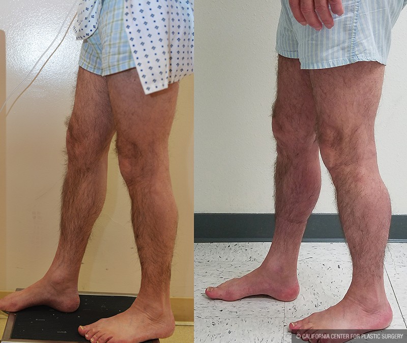 Calf Augmentation Before & After Patient #14692