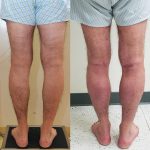 Calf Augmentation Before & After Patient #14692