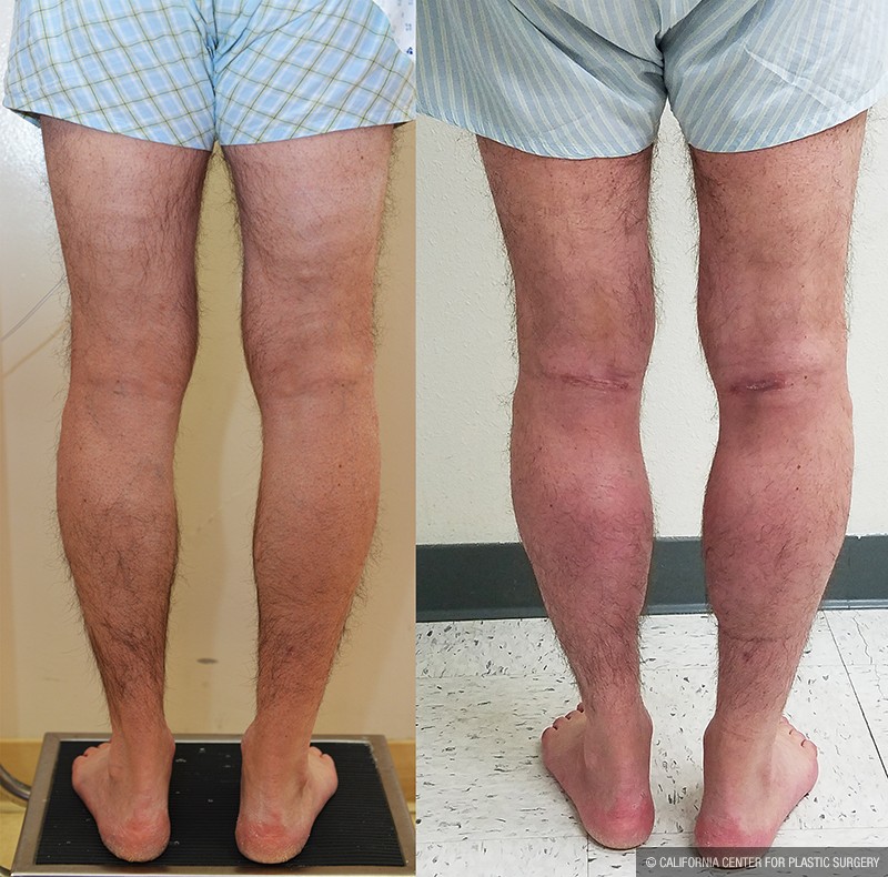 Calf Augmentation Before & After Patient #14692
