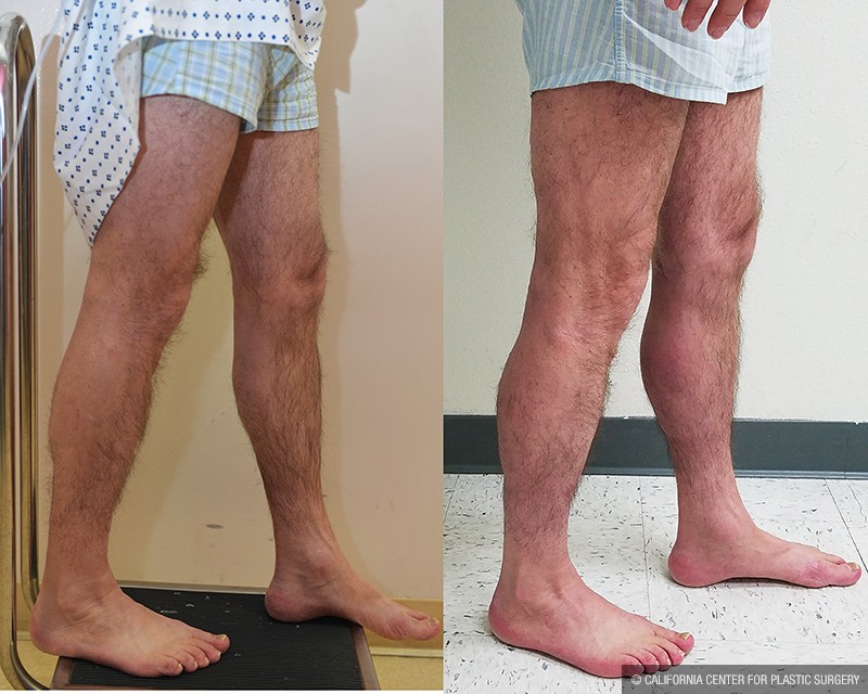 Calf Augmentation Before & After Patient #14692