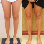 Calf Augmentation Before & After Patient #14693