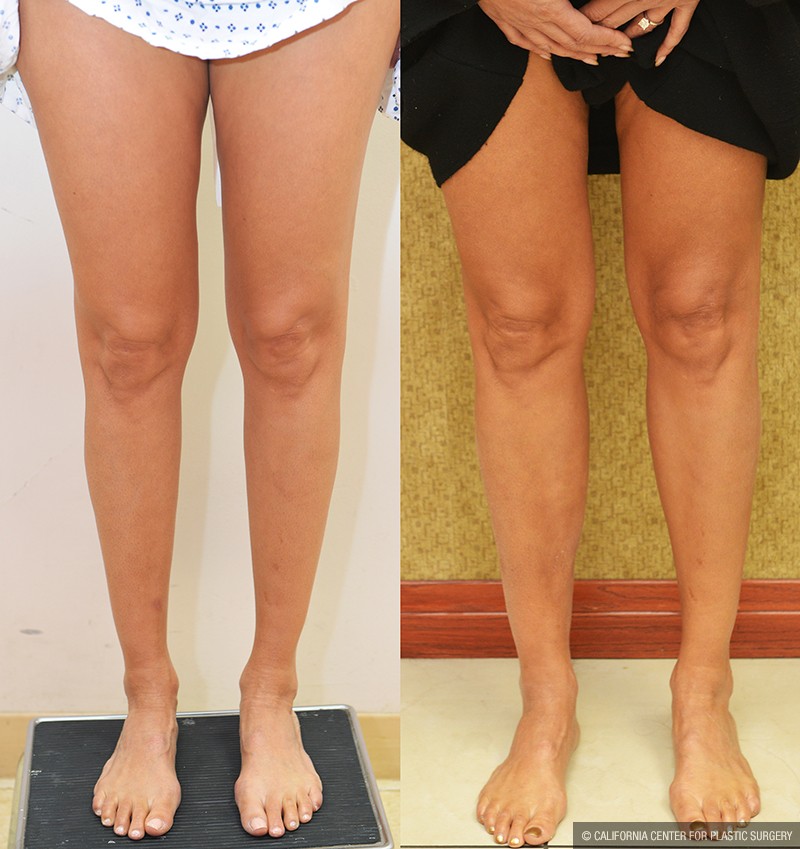 Calf Augmentation Before & After Patient #14693