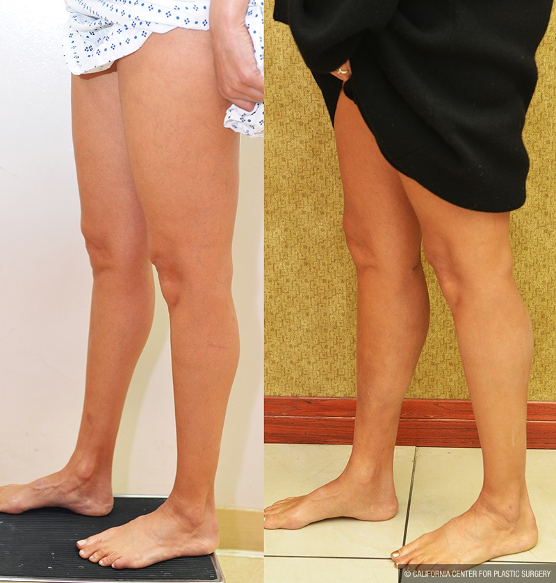 Calf Augmentation Before & After Patient #14693