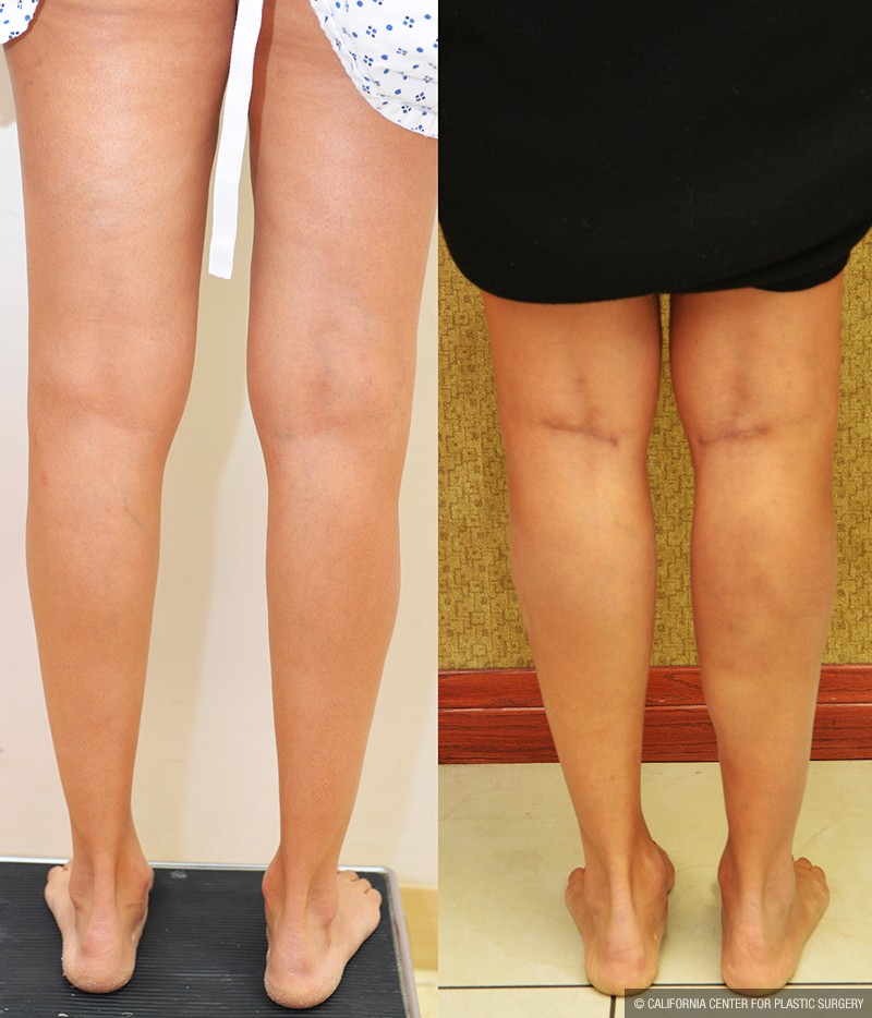 Calf Augmentation Before & After Patient #14693