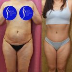 Tummy Tuck (Abdominoplasty) Medium Size Before & After Patient #14696