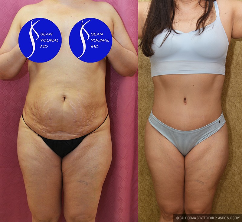 Tummy Tuck (Abdominoplasty) Medium Size Before & After Patient #14696