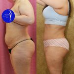 Tummy Tuck (Abdominoplasty) Medium Size Before & After Patient #14696