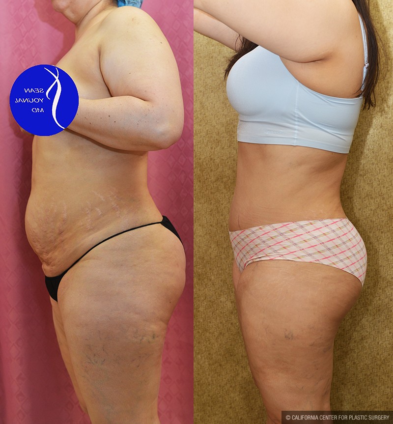 Tummy Tuck (Abdominoplasty) Medium Size Before & After Patient #14696