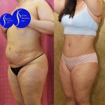 Tummy Tuck (Abdominoplasty) Medium Size Before & After Patient #14696