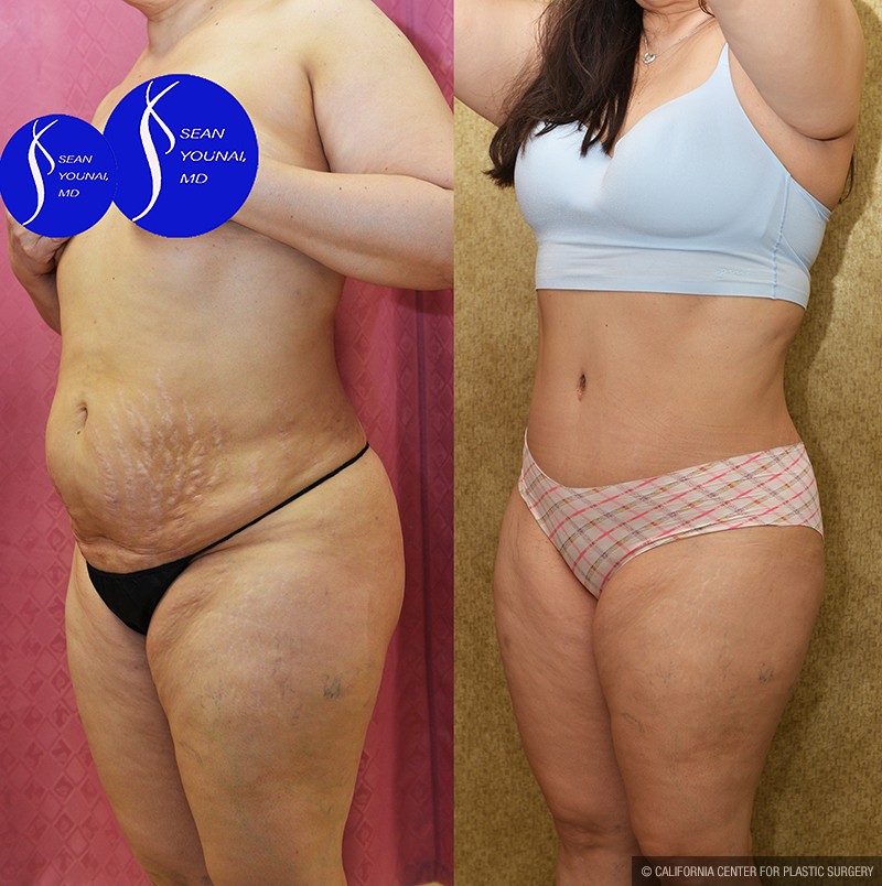 Tummy Tuck (Abdominoplasty) Medium Size Before & After Patient #14696