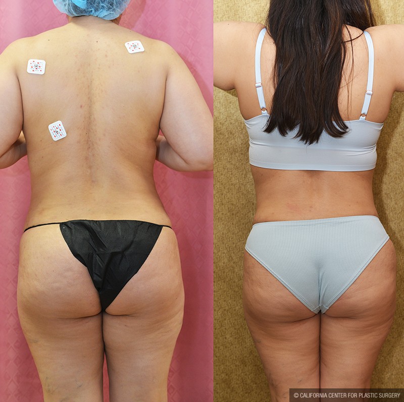 Tummy Tuck (Abdominoplasty) Medium Size Before & After Patient #14696