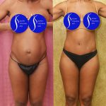 Tummy Tuck (Abdominoplasty) Small Size Before & After Patient #14700