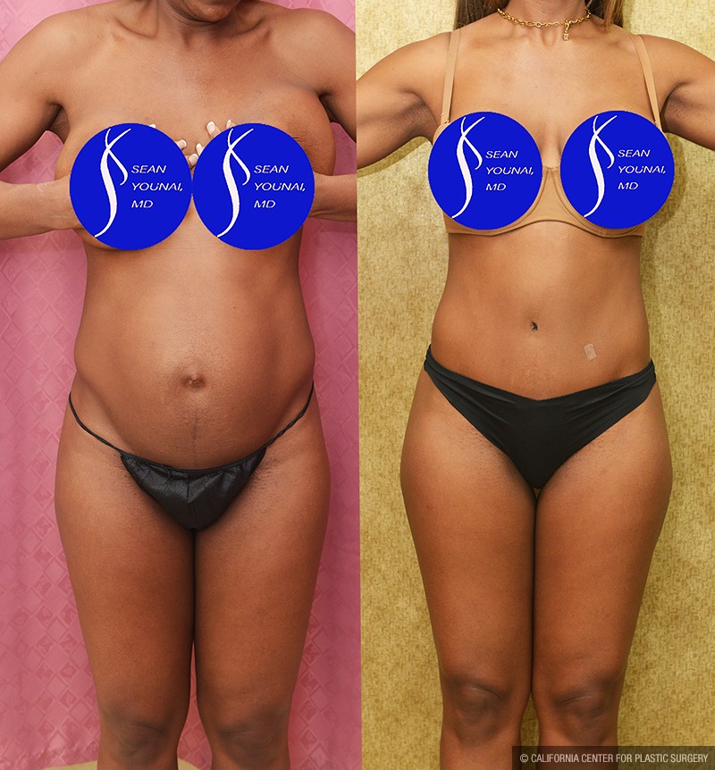 Tummy Tuck (Abdominoplasty) Small Size Before & After Patient #14700