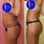 Tummy Tuck (Abdominoplasty) Small Size Before & After Patient #14700
