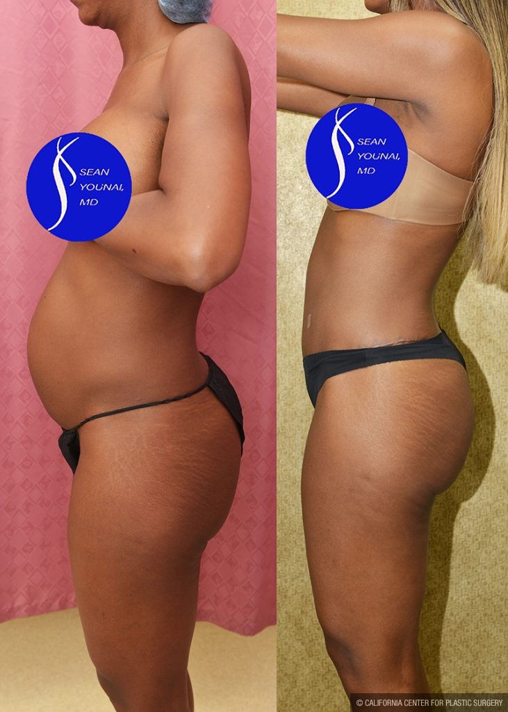 Tummy Tuck (Abdominoplasty) Small Size Before & After Patient #14700