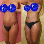 Tummy Tuck (Abdominoplasty) Small Size Before & After Patient #14700