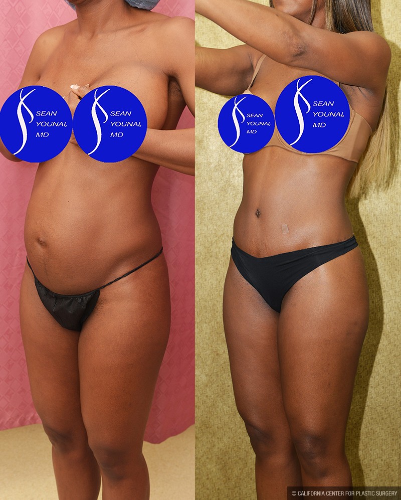 Tummy Tuck (Abdominoplasty) Small Size Before & After Patient #14700