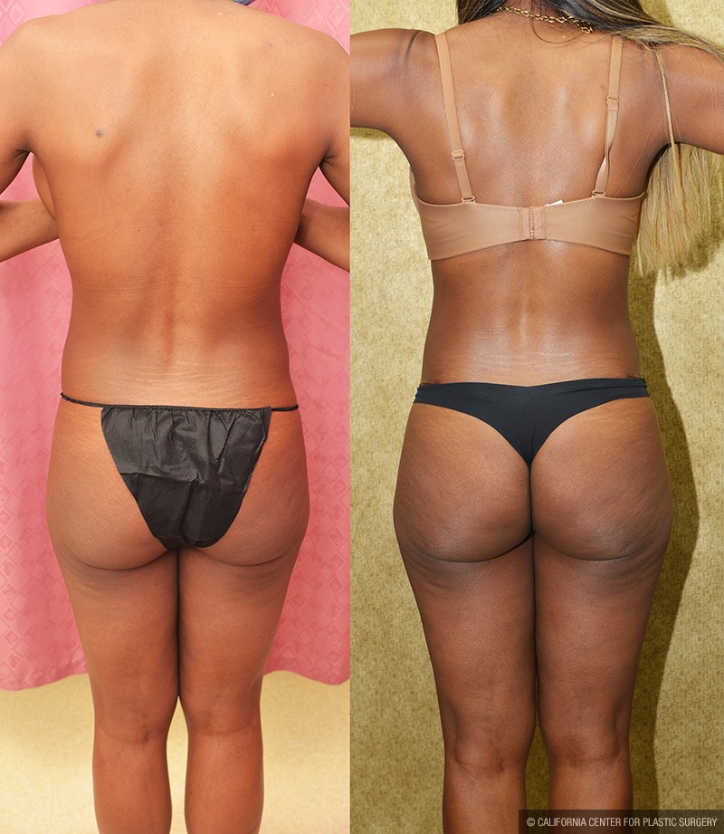 Tummy Tuck (Abdominoplasty) Small Size Before & After Patient #14700