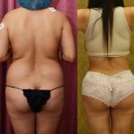 Buttock Lift/Augmentation Before & After Patient #14775