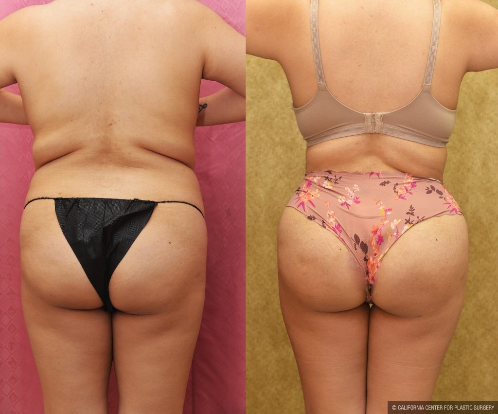 Buttock Lift/Augmentation Before & After Patient #14776