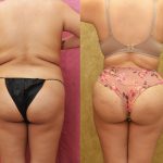 Buttock Lift/Augmentation Before & After Patient #14776
