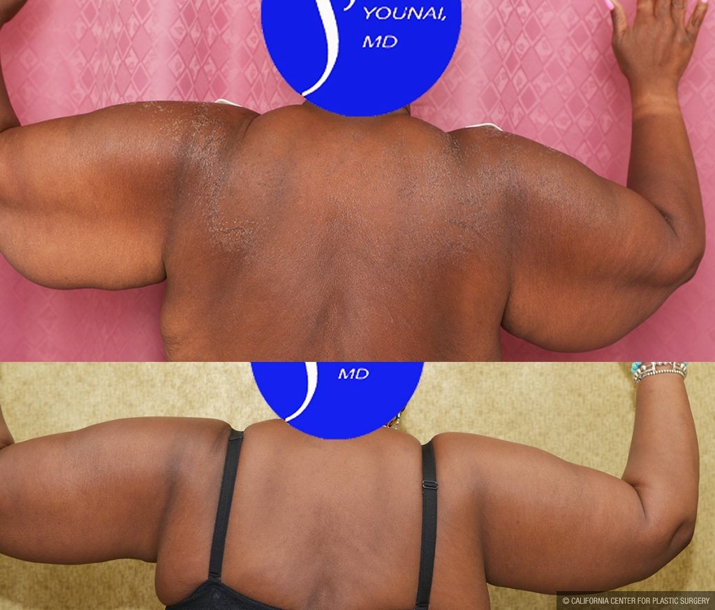 Arm Lift (Brachioplasty) Before & After Patient #14773