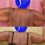 Arm Lift (Brachioplasty) Before & After Patient #14773