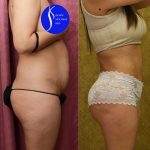 Tummy Tuck (Abdominoplasty) Small Size Before & After Patient #14784