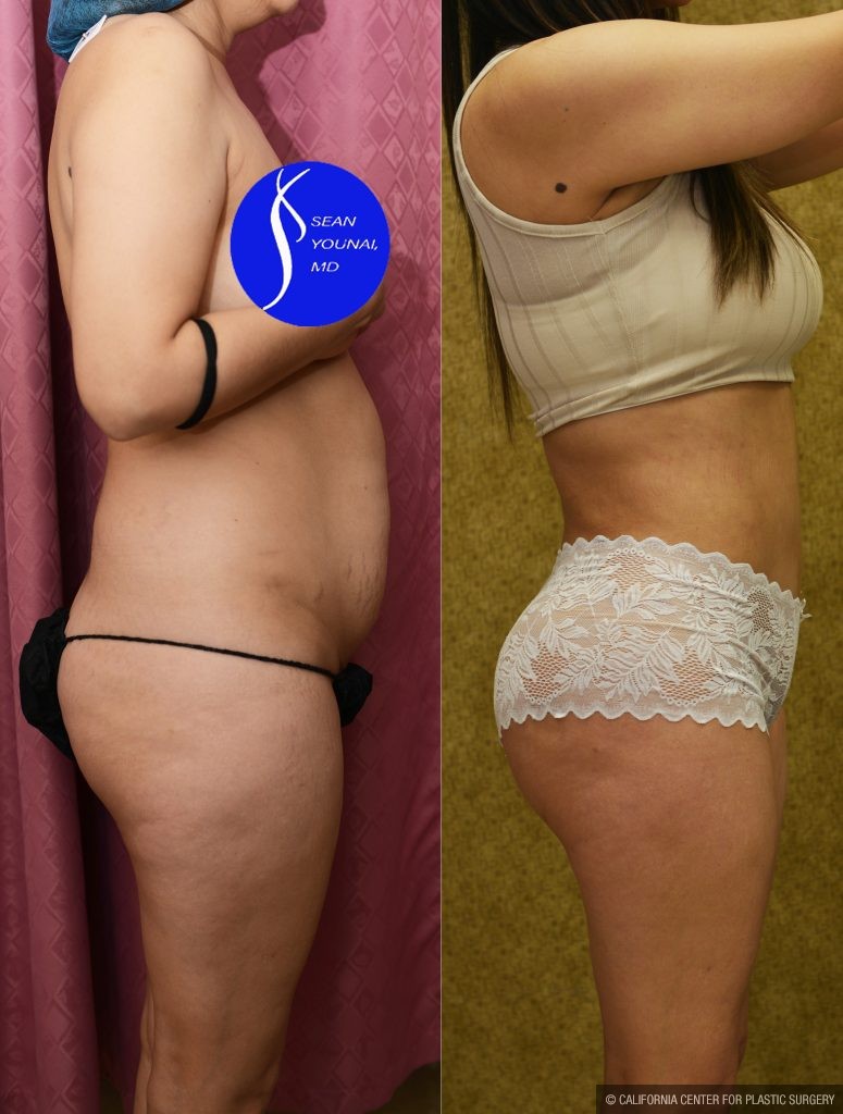 Buttock Lift/Augmentation Before & After Patient #14775