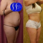 Tummy Tuck (Abdominoplasty) Small Size Before & After Patient #14784