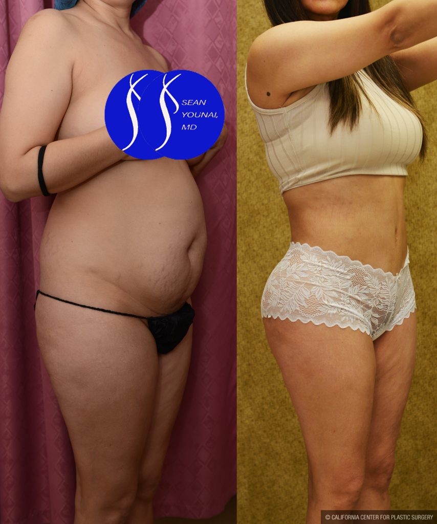 Tummy Tuck (Abdominoplasty) Small Size Before & After Patient #14784