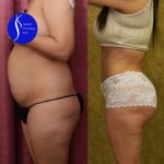 Tummy Tuck (Abdominoplasty) Small Size Before & After Patient #14784